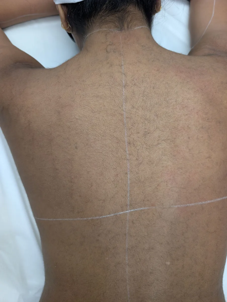 Back before laser hair removal