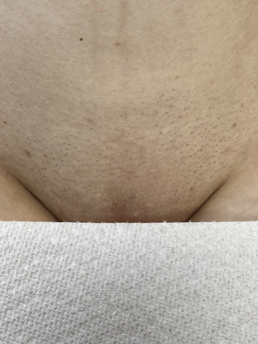 Bikini after laser hair removal