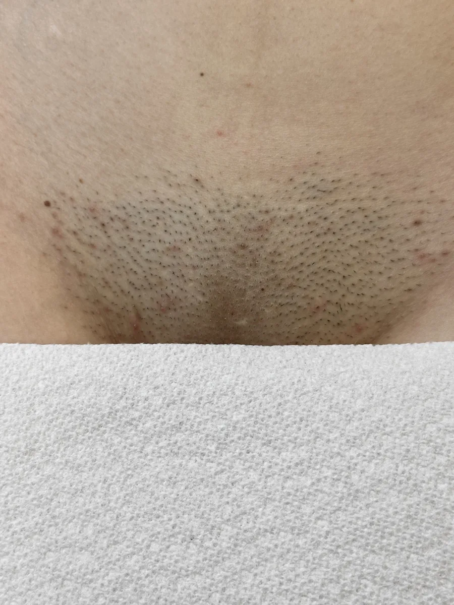 Bikini before laser hair removal