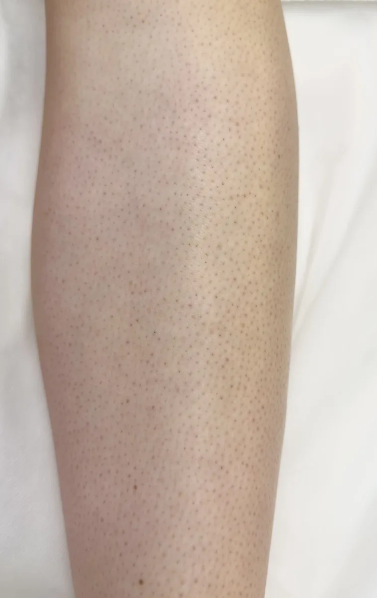 Lower leg after laser hair removal