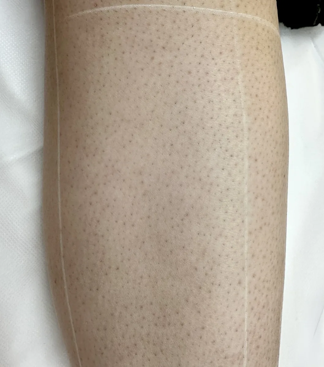 Lower leg before laser hair removal