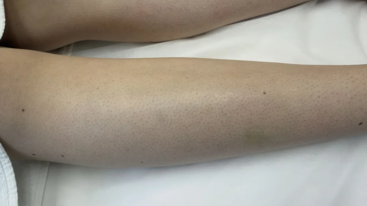 Legs after laser hair removal