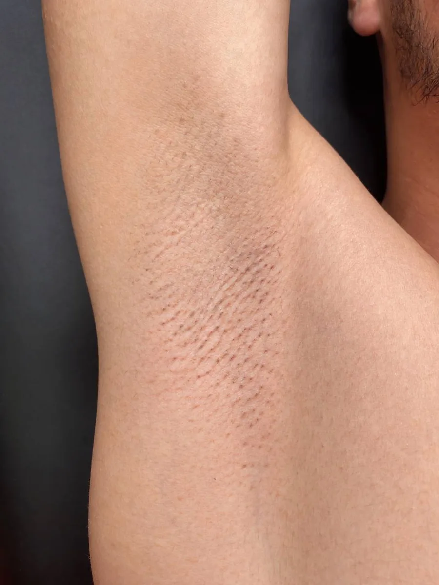 Underarms after laser hair removal