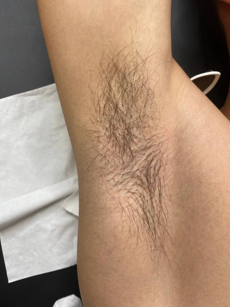 Underarms before laser hair removal