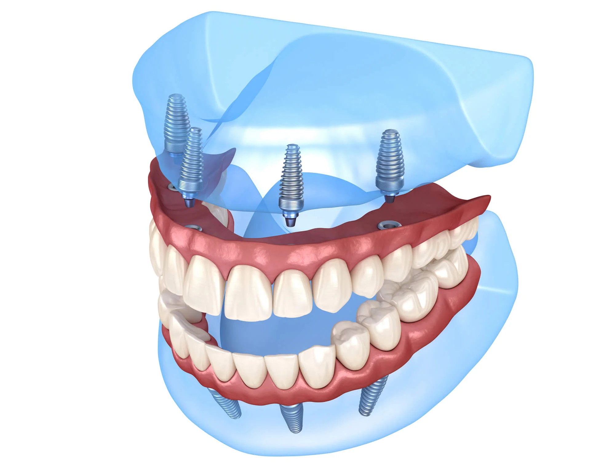 Full arch model all on 4 dental implants in Spring Hill