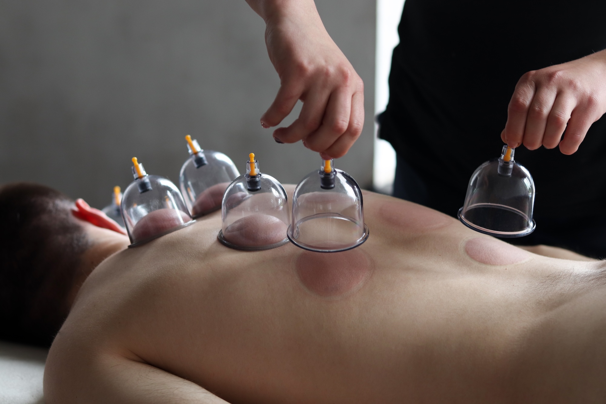 cupping-therapy-connecticut