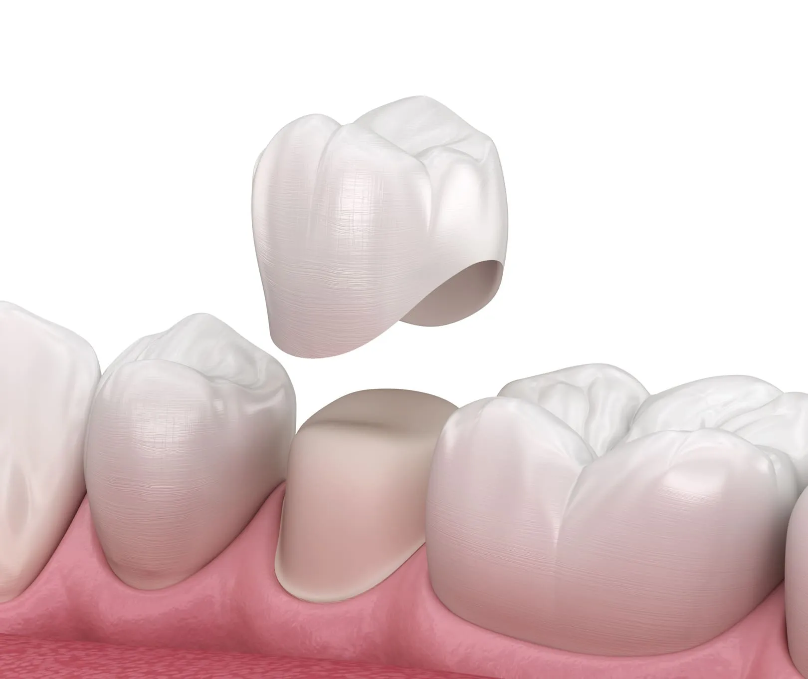 Porcelain Crowns in Braintree, MA