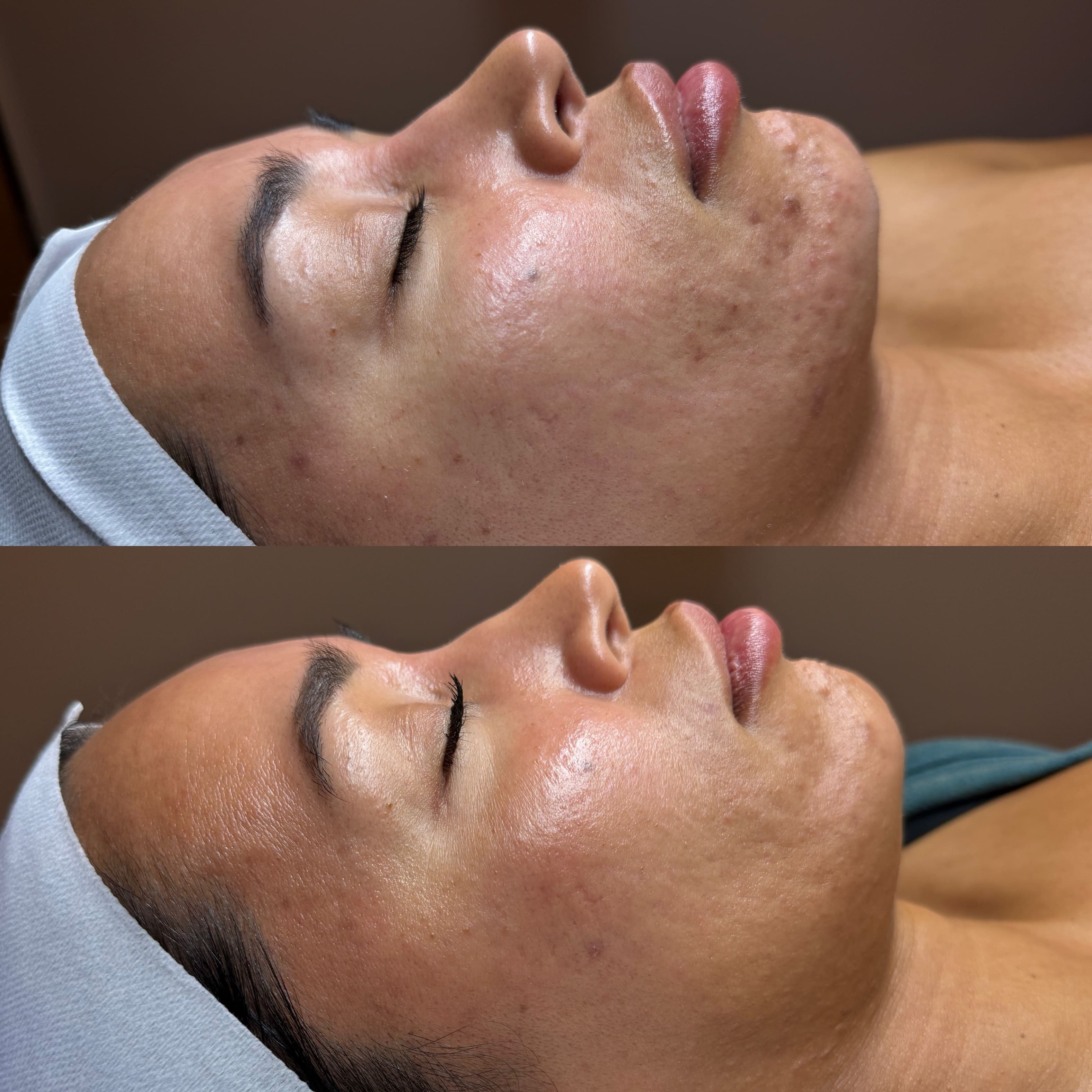 Close up of skin texture and pores before microneedling treatment in Queen Creek, Arizona