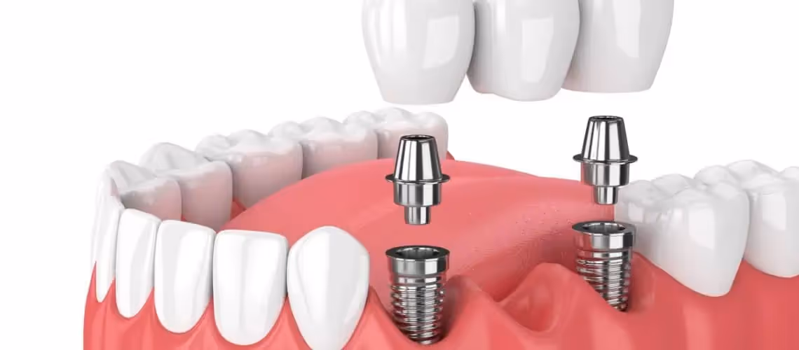 ¿Cuáles son los beneficios de los miniimplantes dentales?