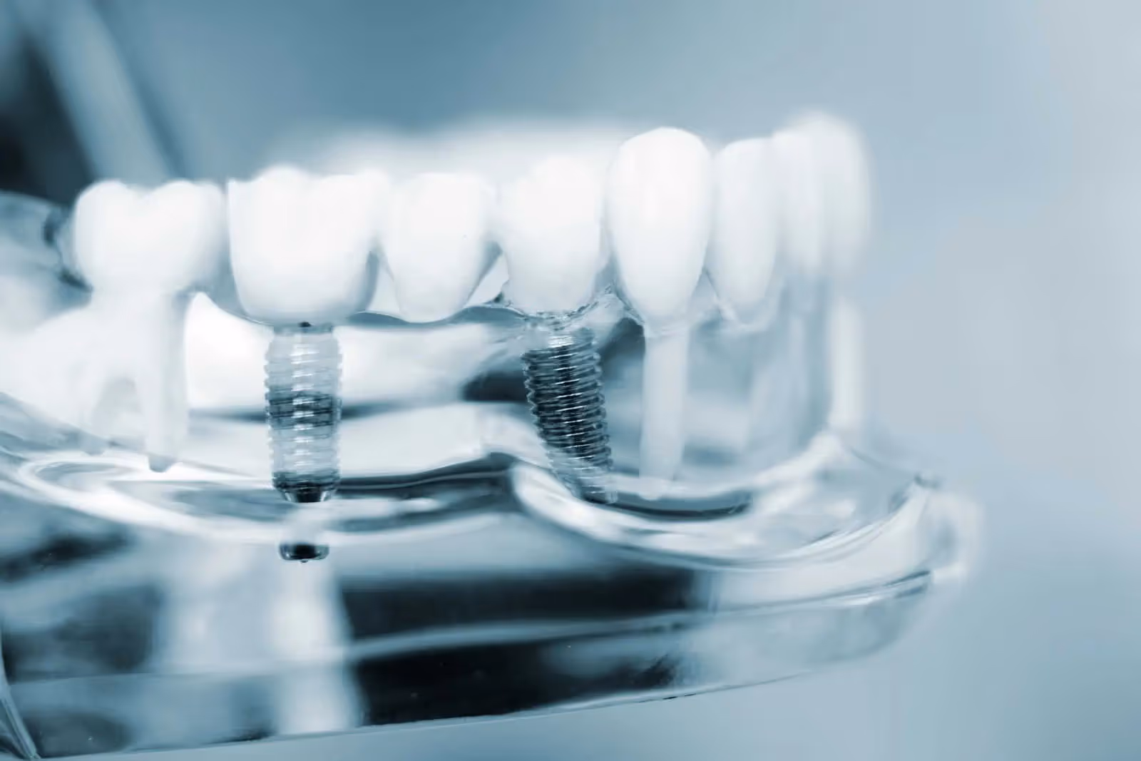 5 cosas que debe saber antes de ponerse implantes dentales