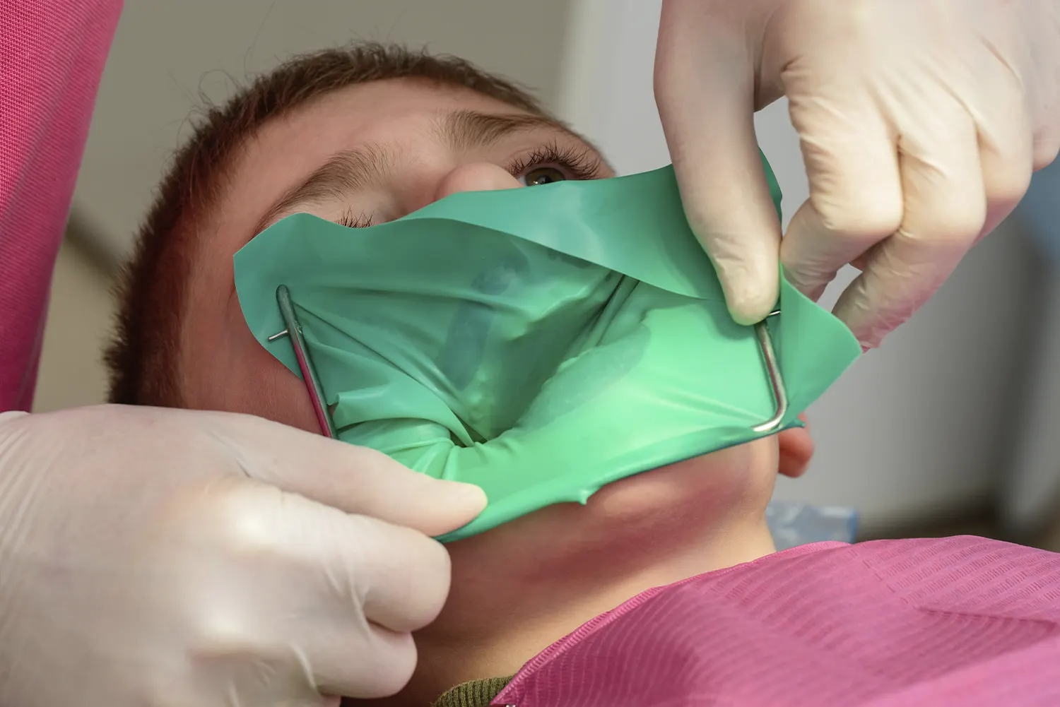 Pulpotomies in Lafayette | Little Cloud Pediatric Dentistry