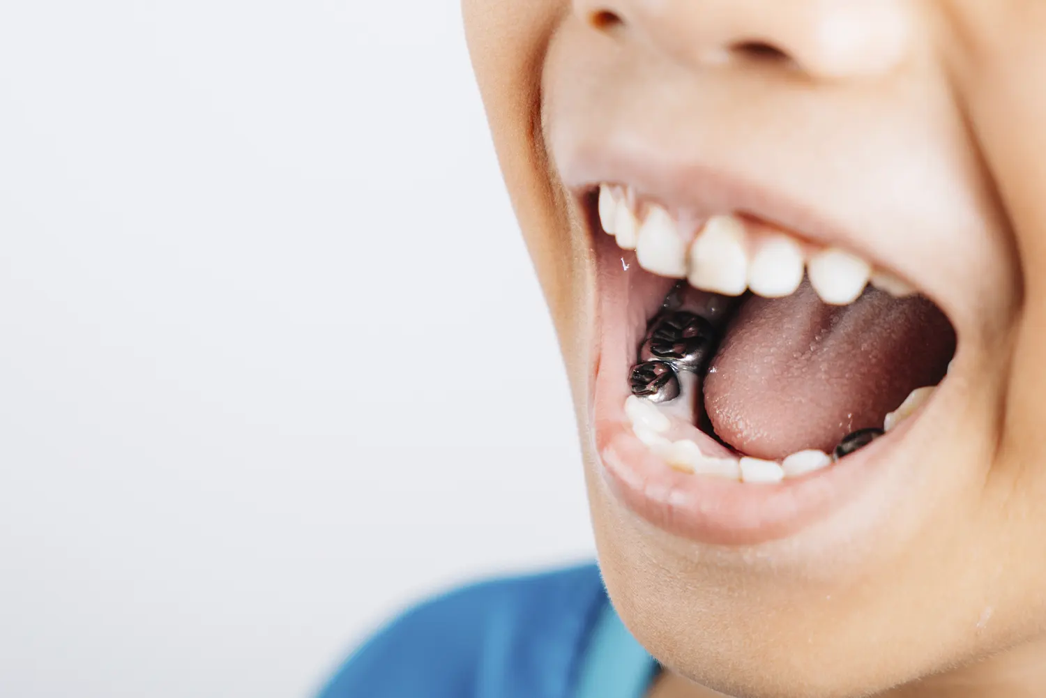 Pediatric Stainless Steel Crowns in Lafayette | Little Cloud Pediatric Dentistry
