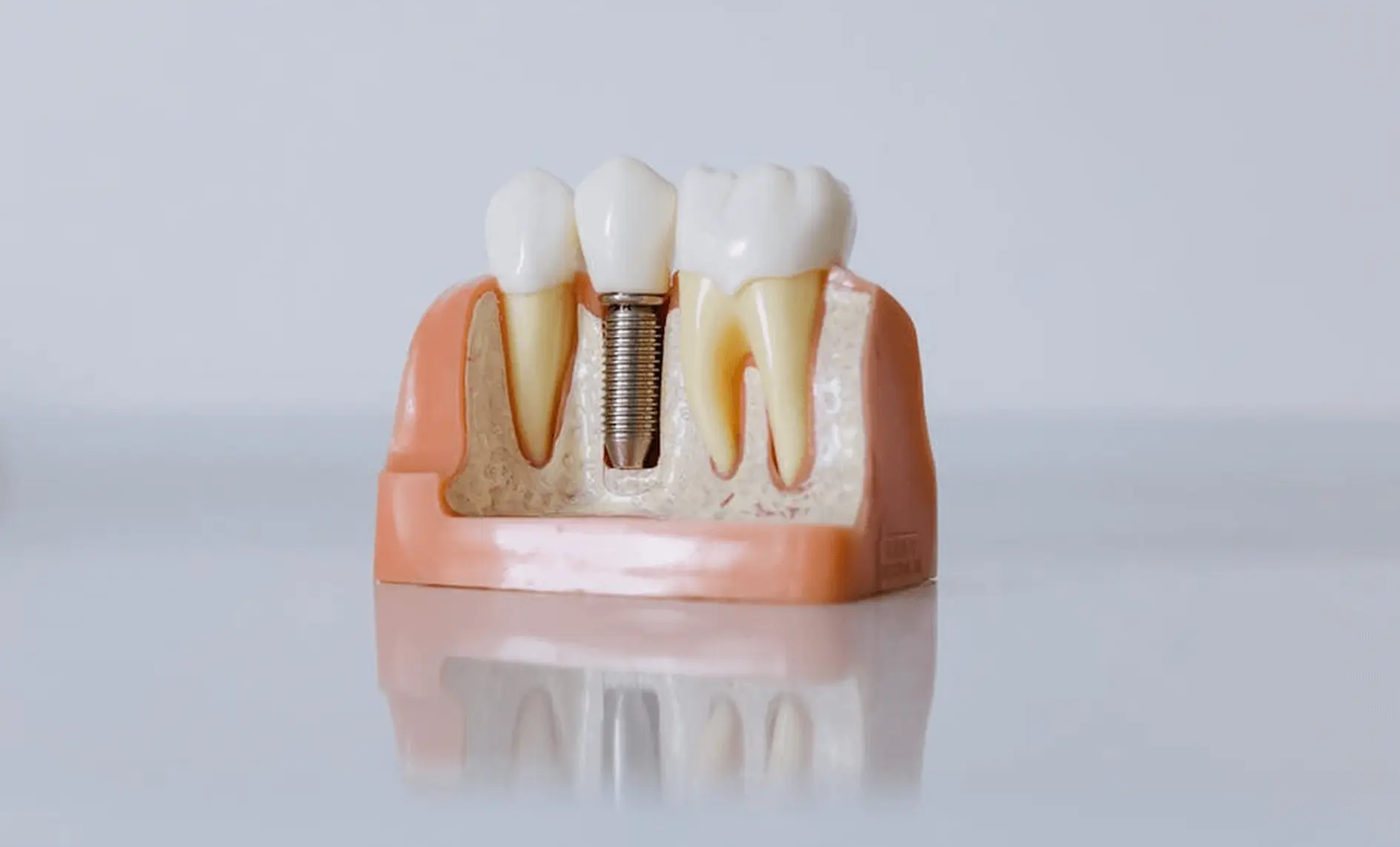 Closeup of a model of a mouth with the anatomy of a dental implant for missing teeth