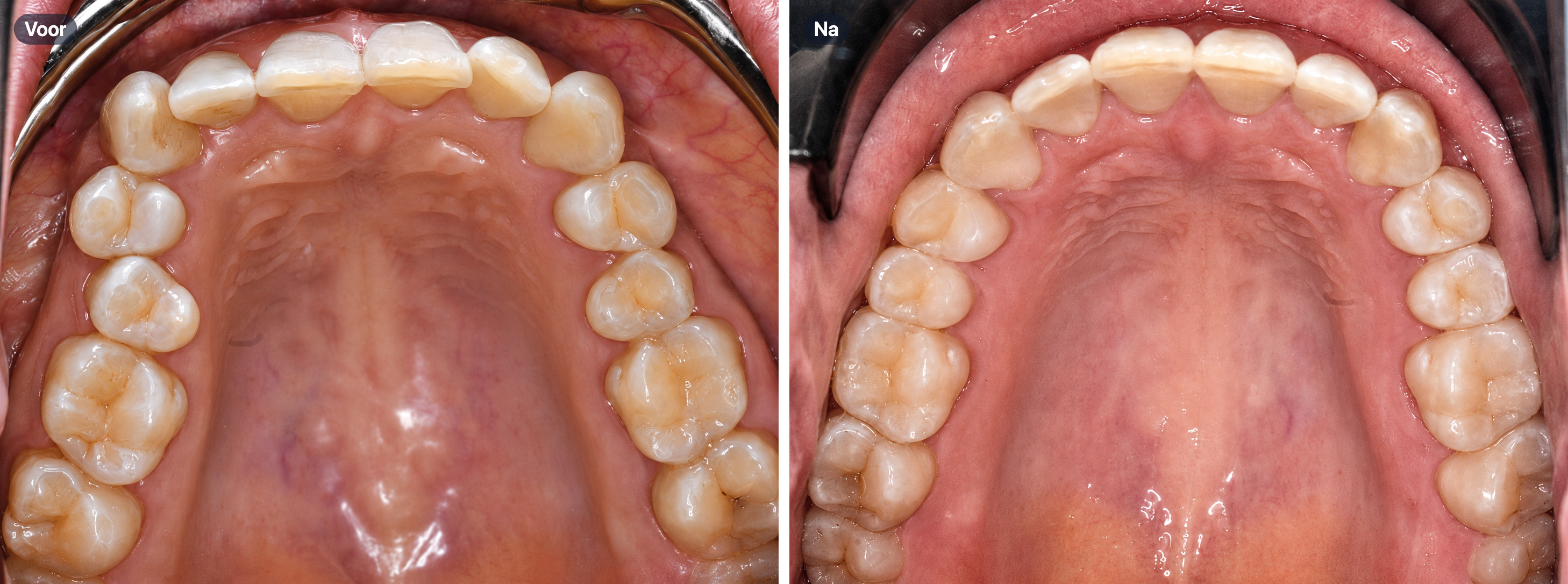 Voor en na clear aligners behandeling bij Tandcentrum De Pinte