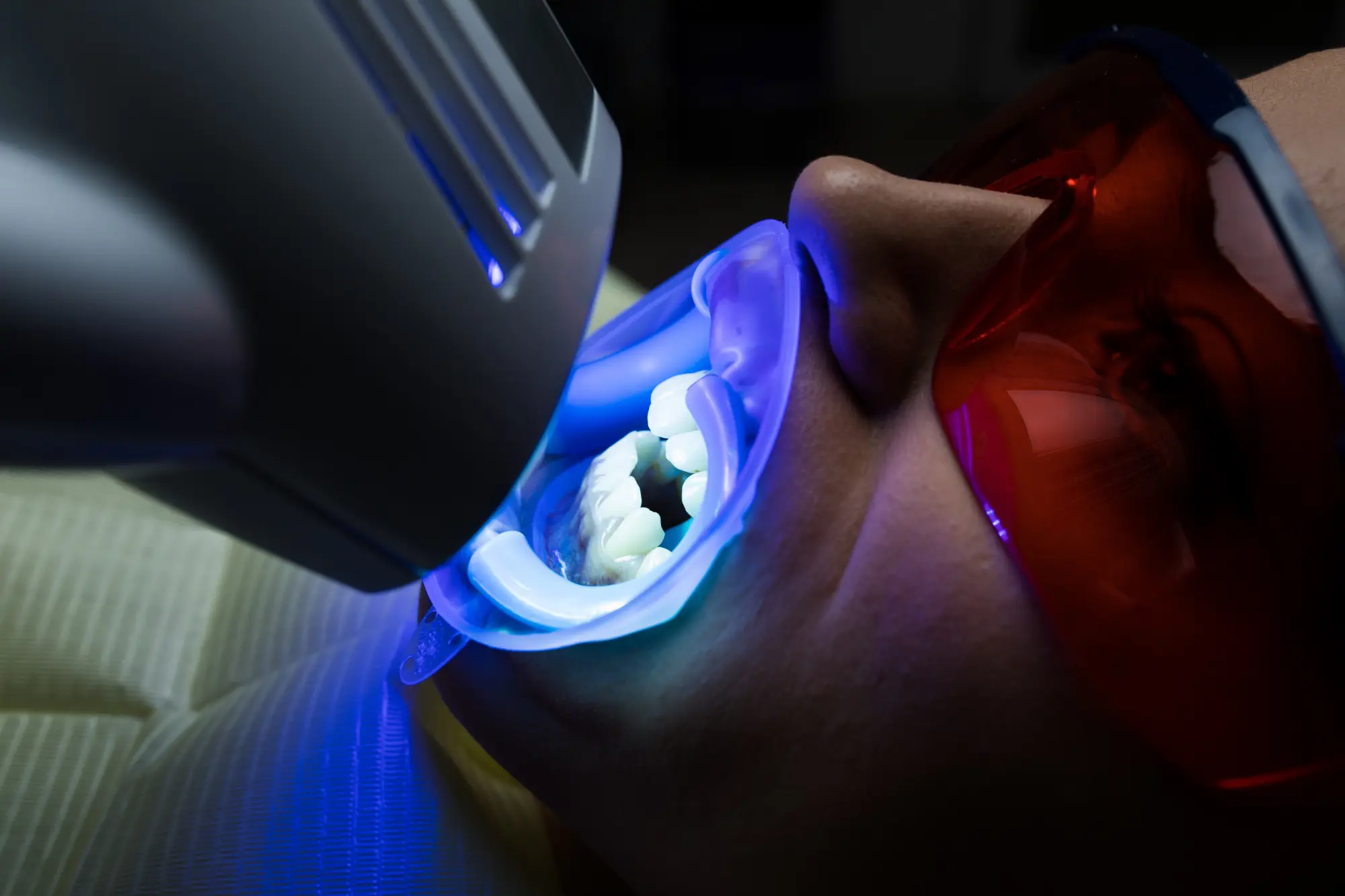 Teeth Whitening in Lubbock, TX | Express Dental Studio