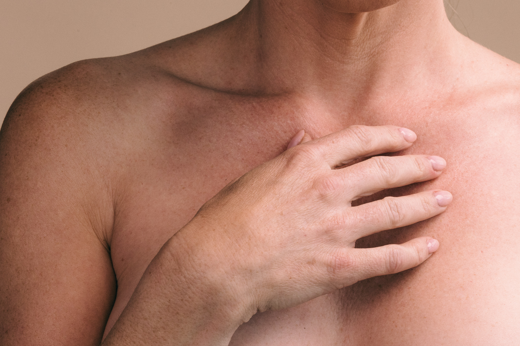 Sculptra for Non-Surgical Skin Tightening for the Body