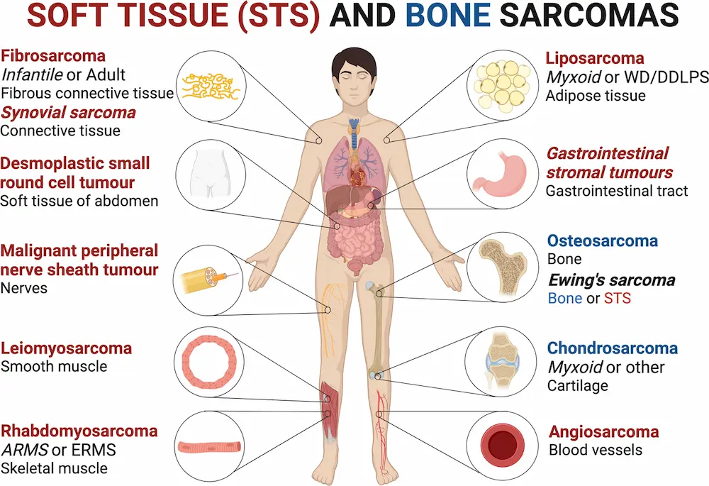 Soft tissue tumours and sarcomas of the body
