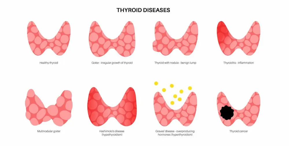 Types of thyroid disorders including glands, cancer, nodues