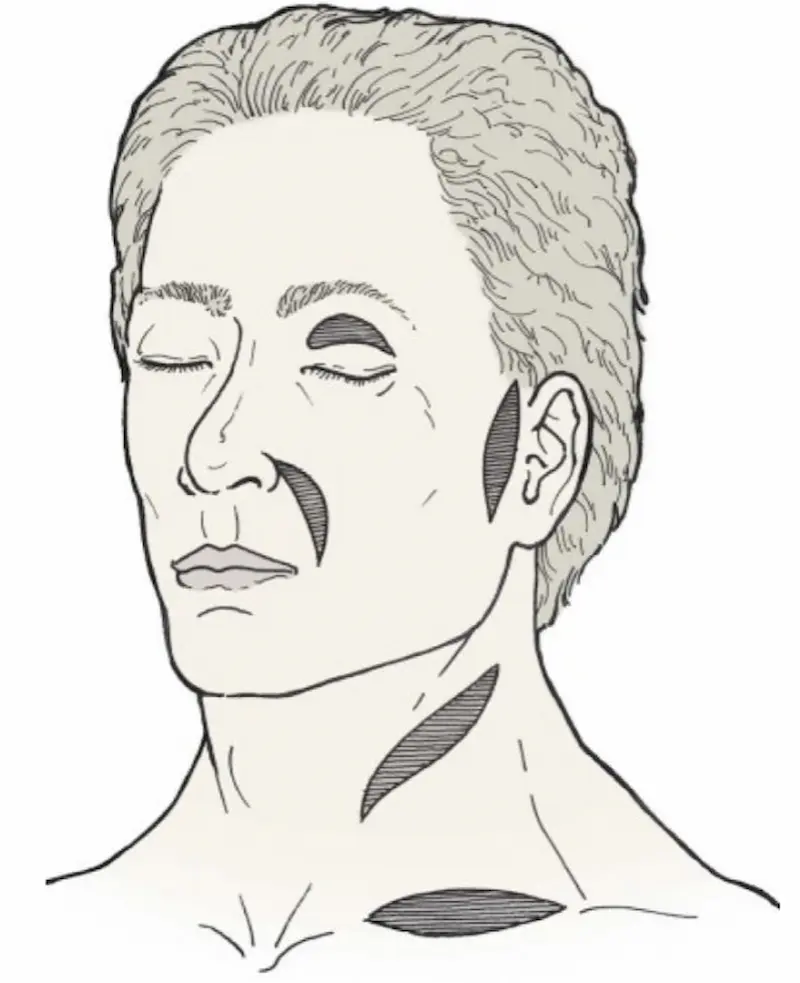 Common sites skin graft face