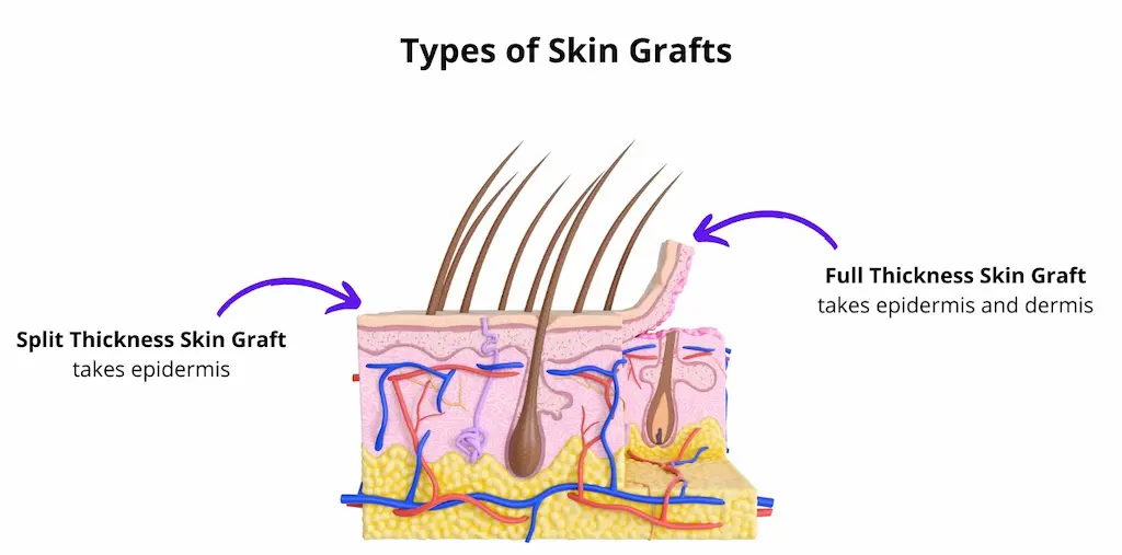 Skin graft types