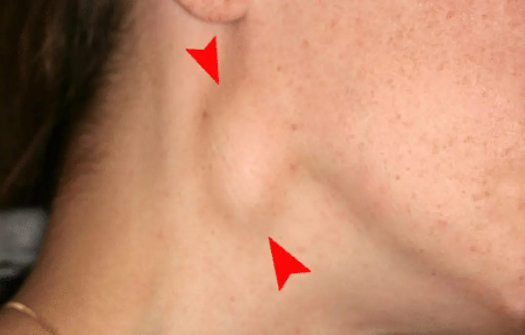 Neck lumps