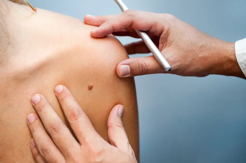 Skin cancer mole on skin