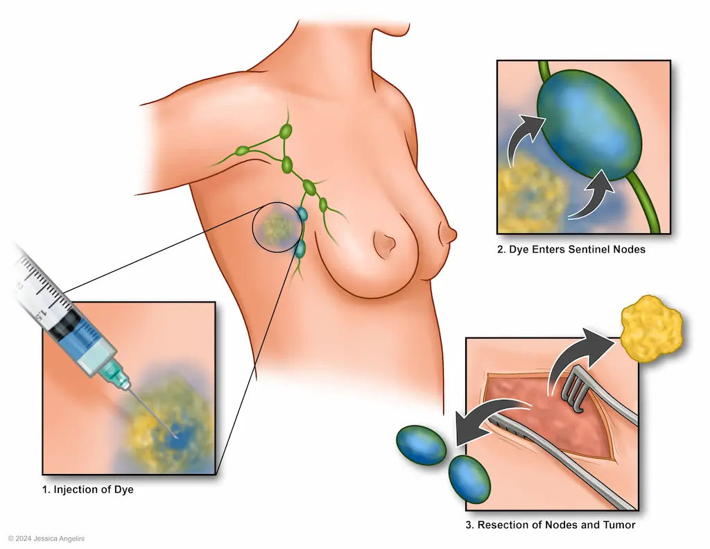 Sentinel Node Biopsy steps Sydney Hills Hornsby