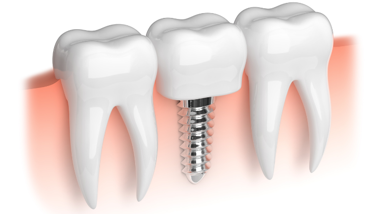 Why Dental Implants in Turkey Are More Affordable Than in Europe | Affordable Dental Implant Turkey 2025