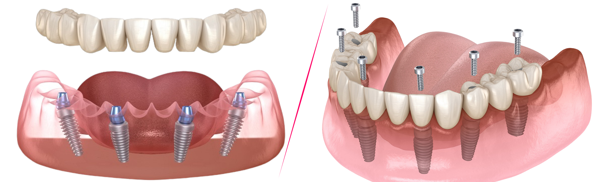 Dental Implants in Turkey: All-on-4 vs All-on-6 — Which Full-Arch Solution Is Better for You?