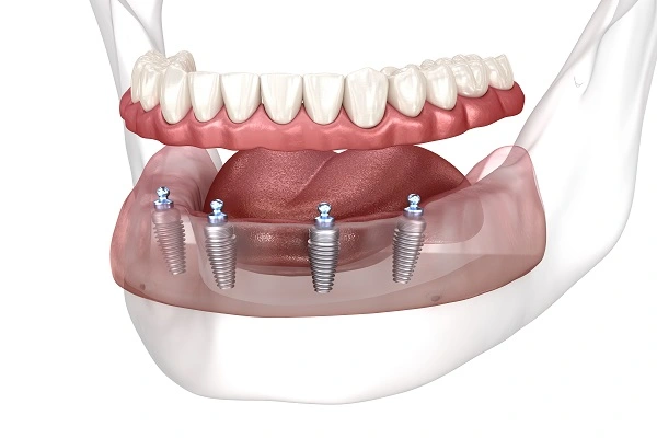 All-on-Four dental implant system supporting full arch prosthetic teeth