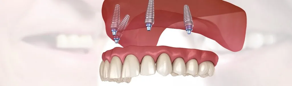 All-on-Four dental implant system supporting full arch prosthetic teeth