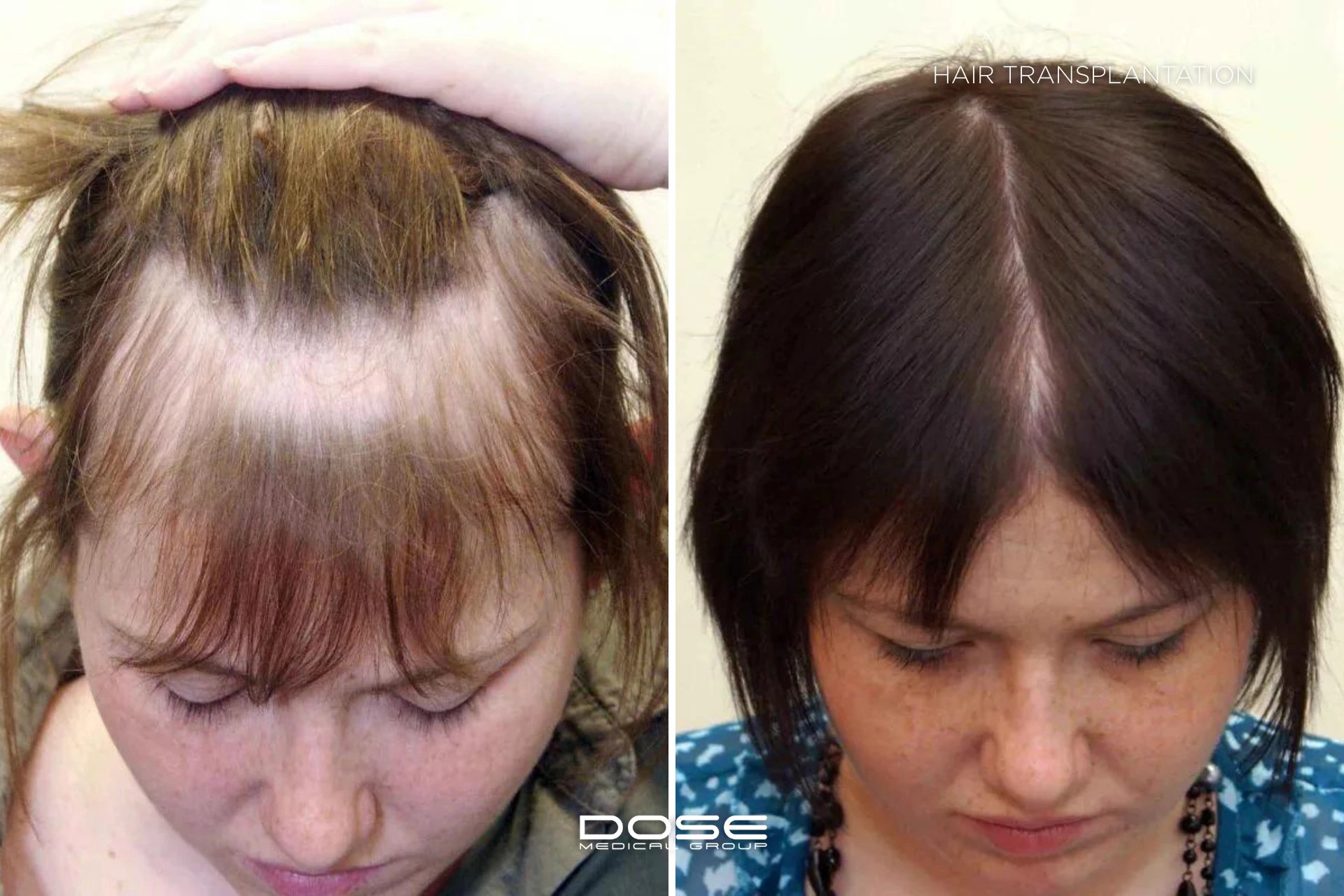 Hair transplantation woman