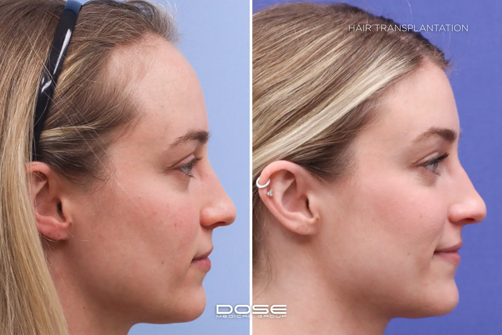 Hair transplantation woman