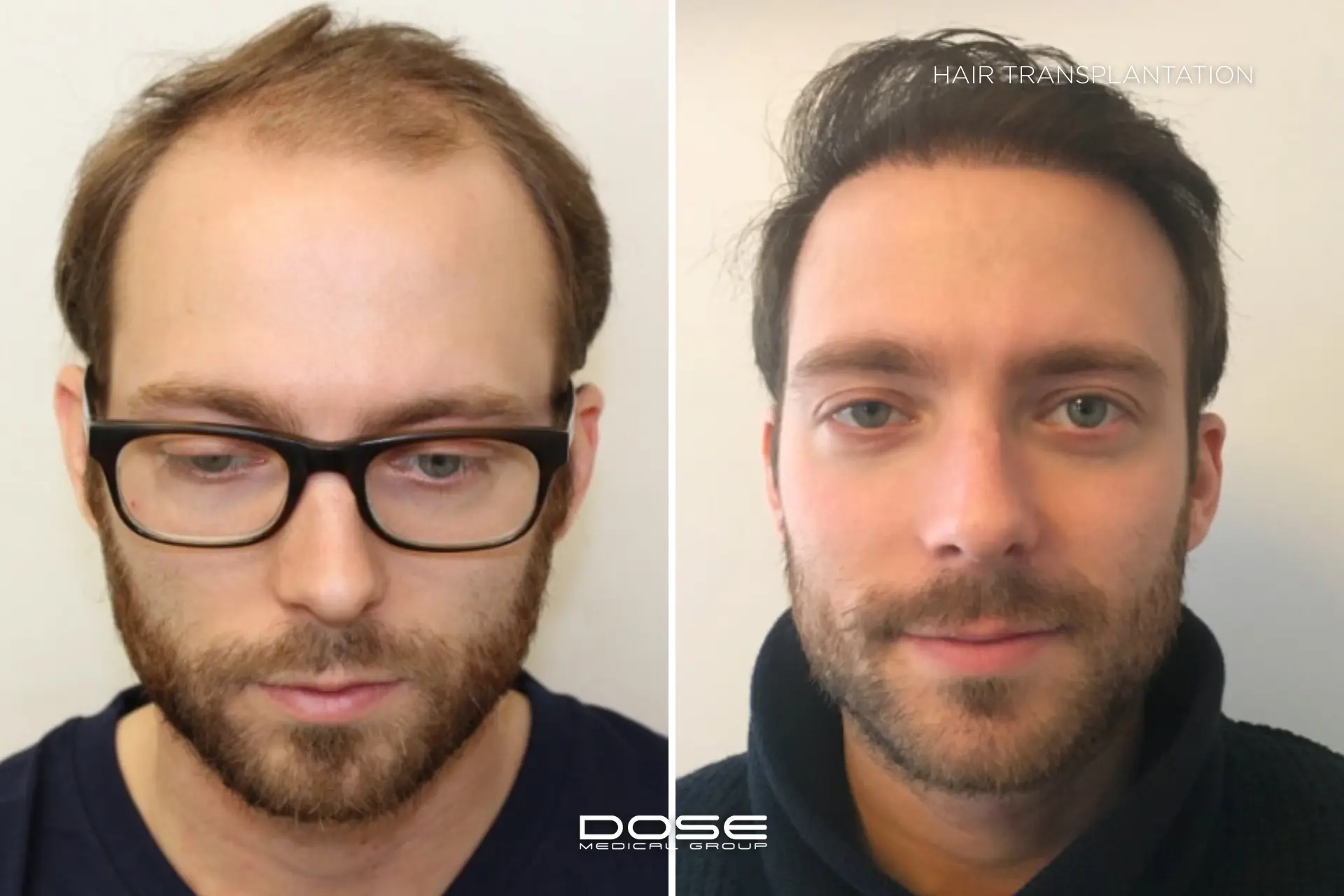 Hair transplantation man