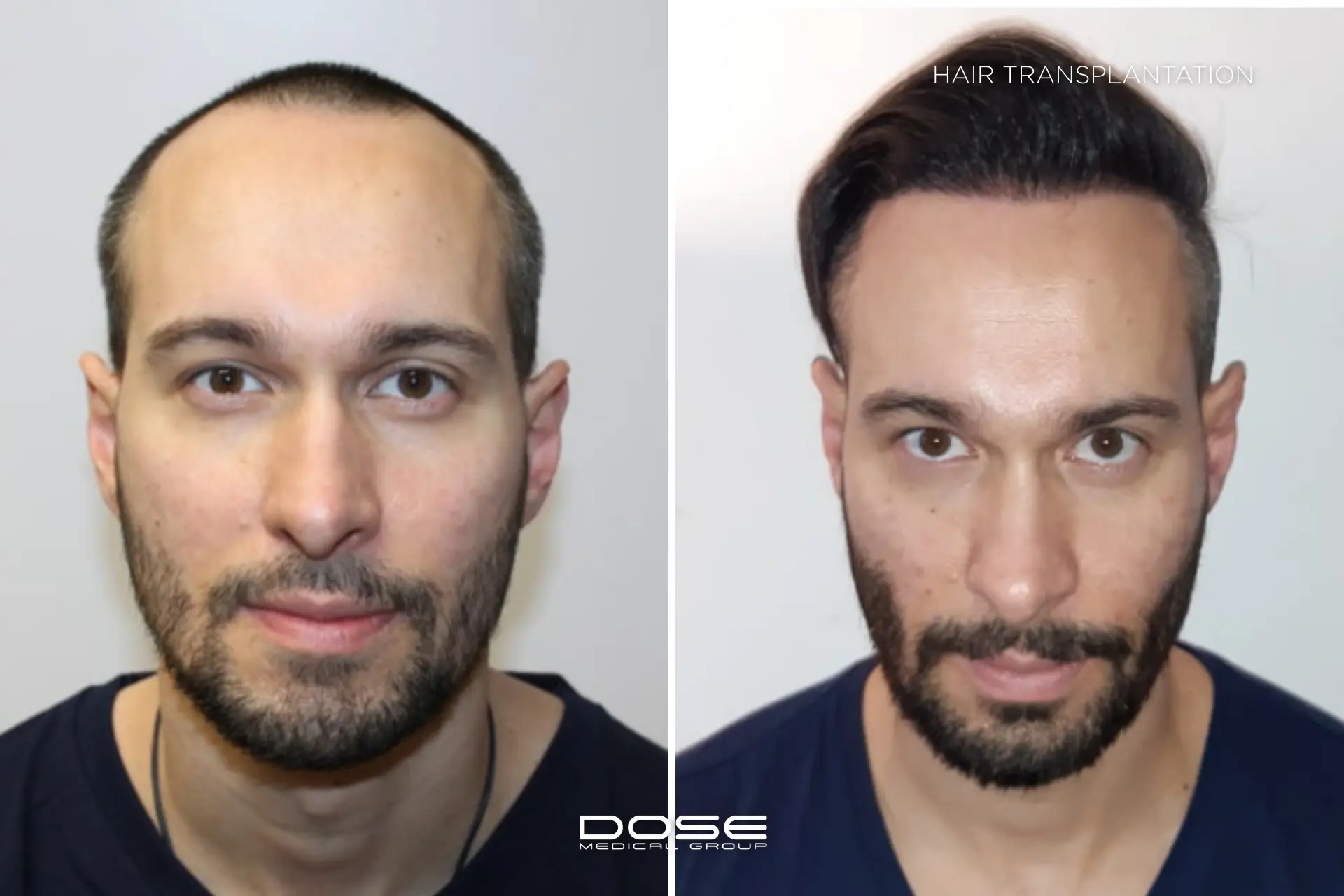 Hair transplantation man