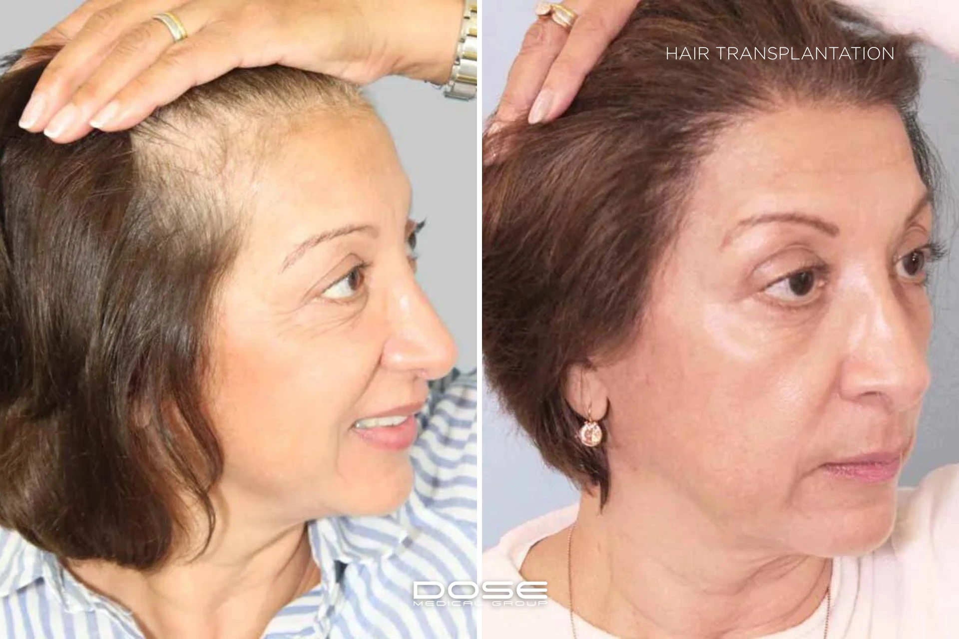 Hair transplantation woman