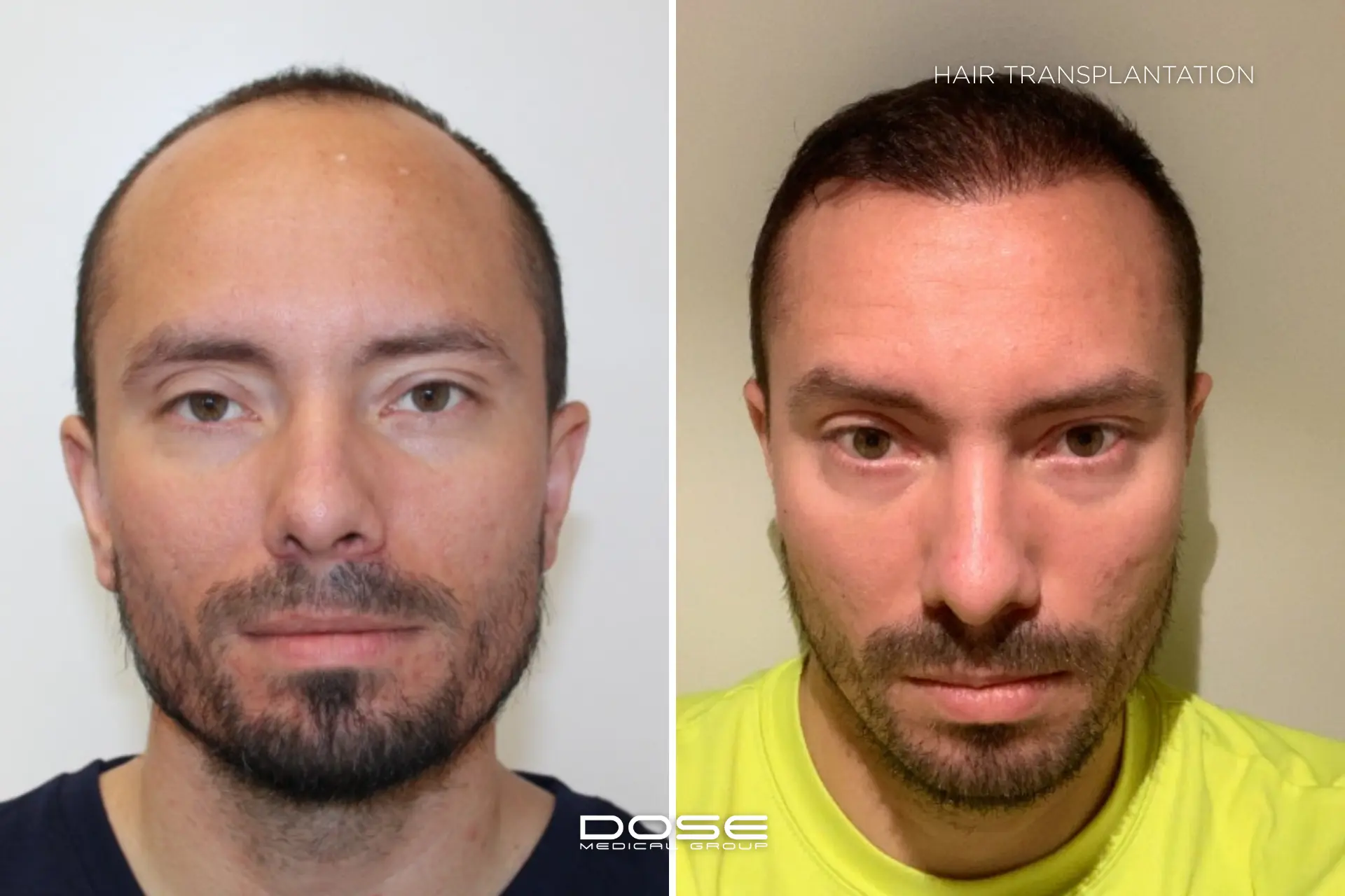 Hair transplantation man