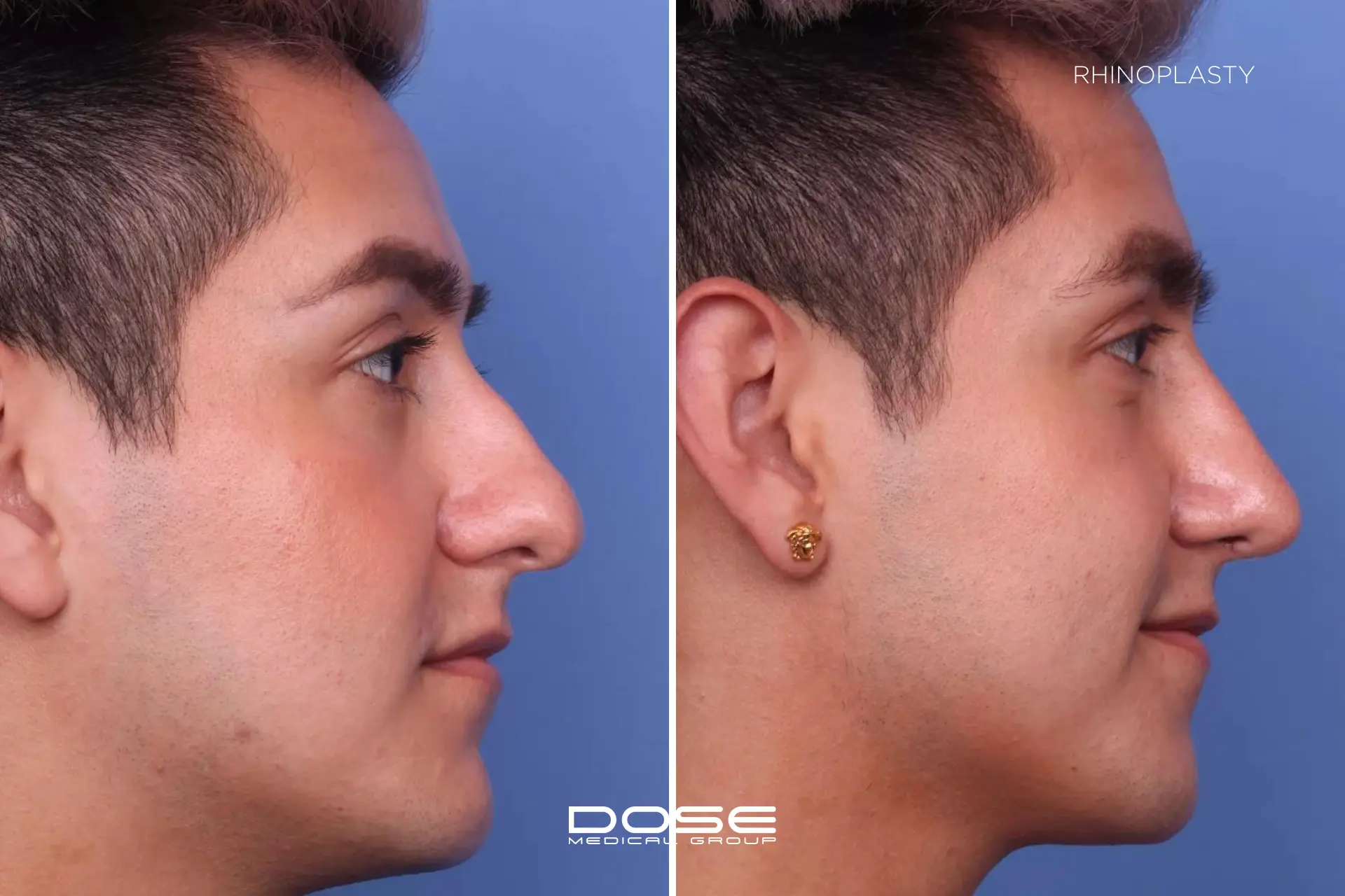 Rhinoplasty 