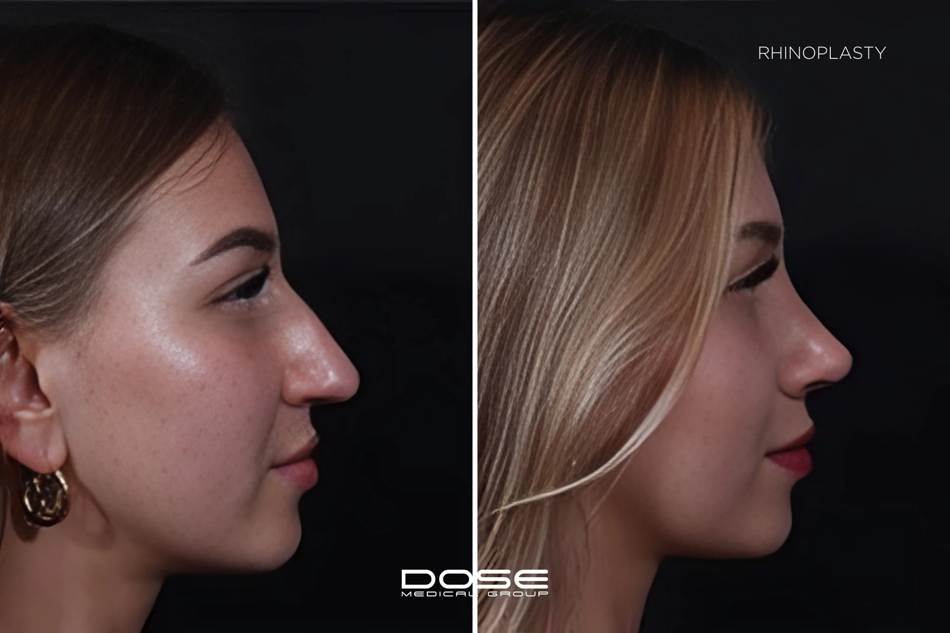 Rhinoplasty 