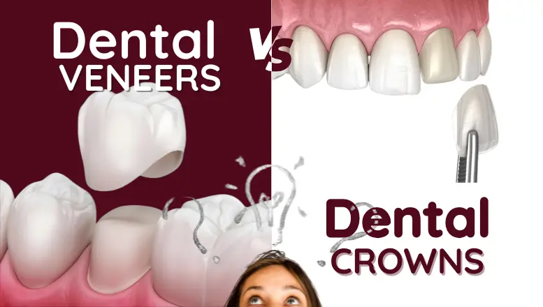 Veneers vs Crowns: Pros, Cons, Costs & Which Is Right for You