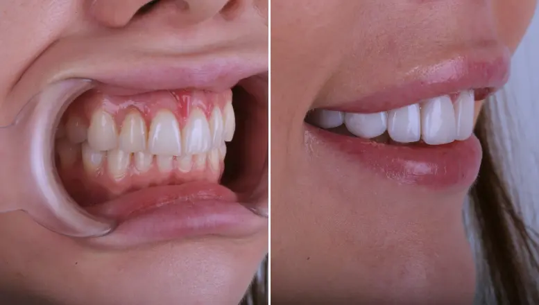 Before-and-after comparison of dental veneers correcting discoloration and shape irregularities