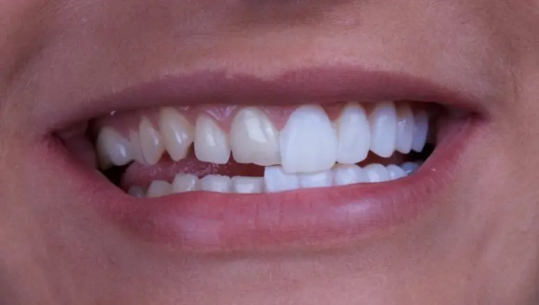 Porcelain veneers