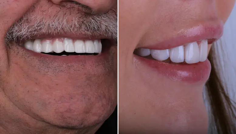 Veneers vs crowns cosmetic dentistry comparison