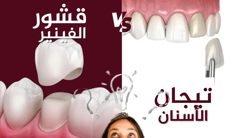 الفينير أم التيجان؟ المميزات، العيوب، التكلفة وأيهما الأنسب لك