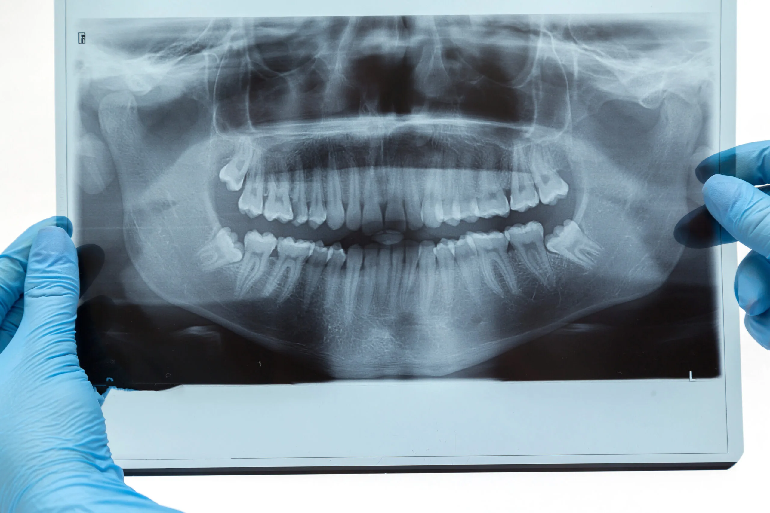 Why Bone Grafts Matter for Dental Implants?