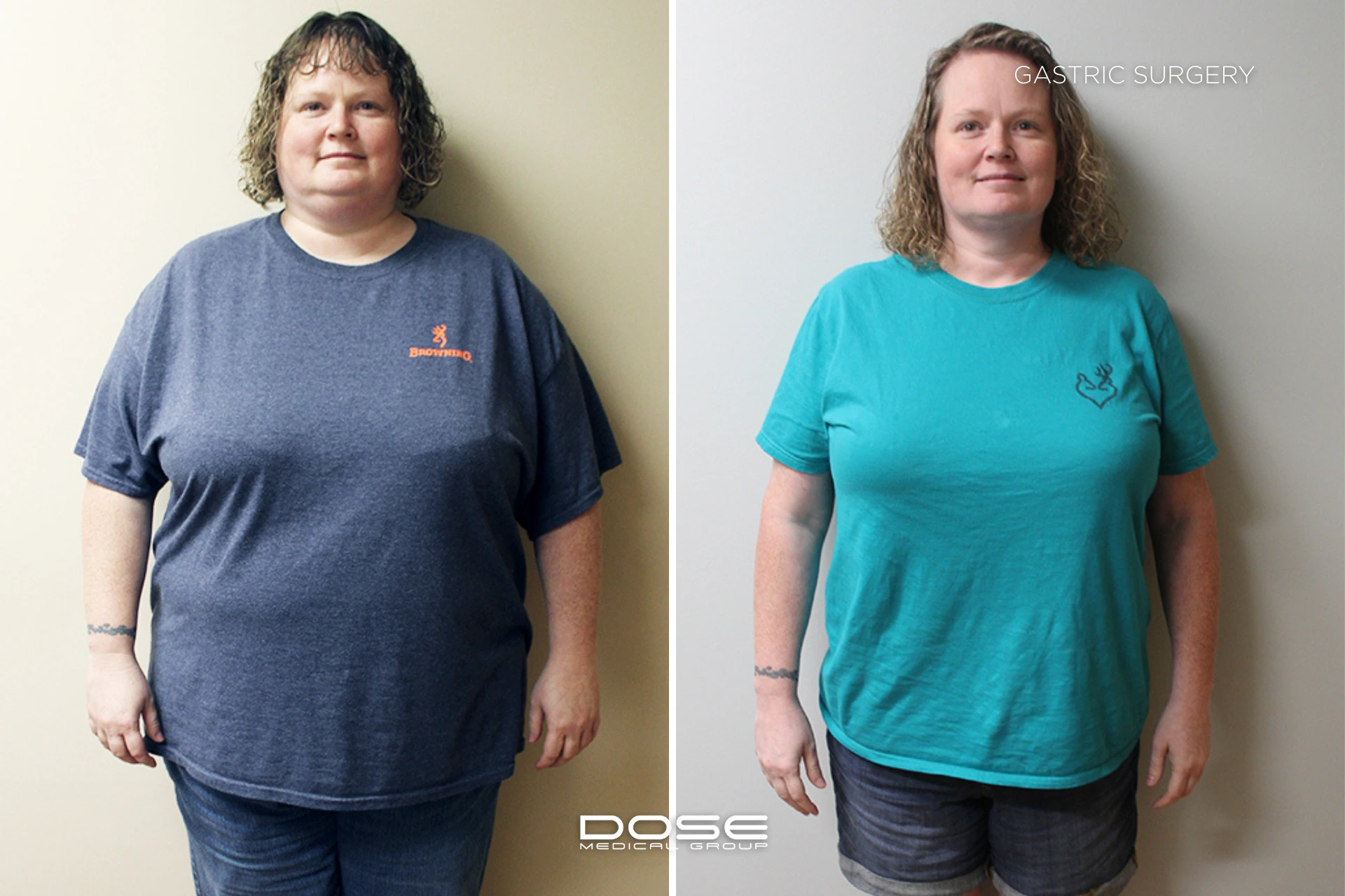 Real patient journeys highlight the emotional and physical transformation possible through bariatric procedures in Turkey.