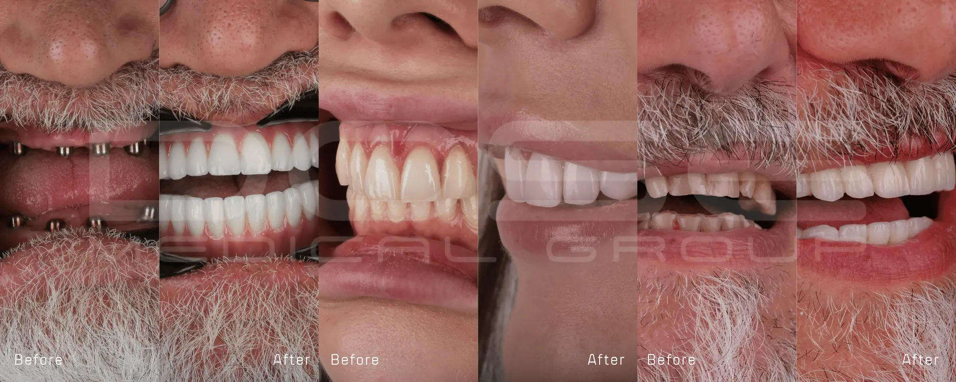 Hollywood Smile Makeover – 2026 Costs in Turkey