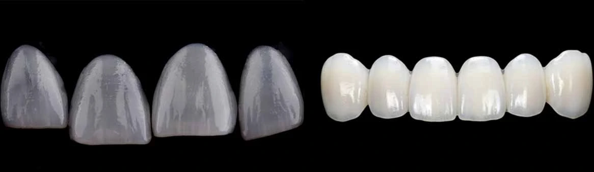 Porcelain veneers macro detail showing natural translucency”