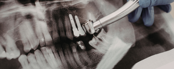 Common Mistakes Patients Make When Getting Dental Implants Abroad | Complete Guide 2026