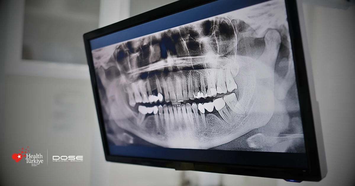 Common Mistakes Patients Make When Getting Dental Implants Abroad